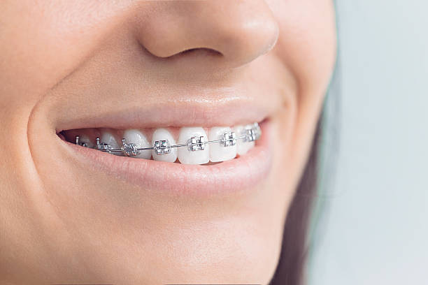 Best Wisdom Tooth Removal  in Carlyss, LA